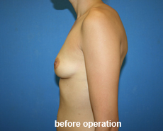 plastic-surgery-breast-augmentation